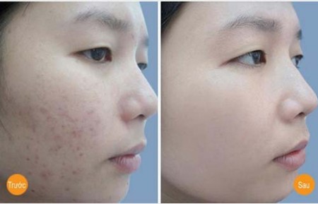 Cho chanh vào tủ đá đông lạnh rồi đắp mặt và cái kết ngọt sau 2 tuần sử dụng