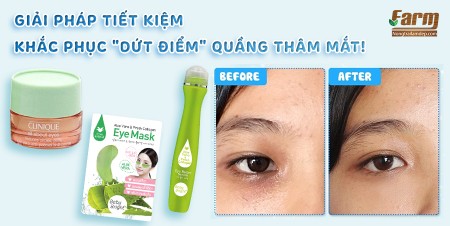 Quầng thâm mắt - nguyên nhân và bí quyết khắc phục