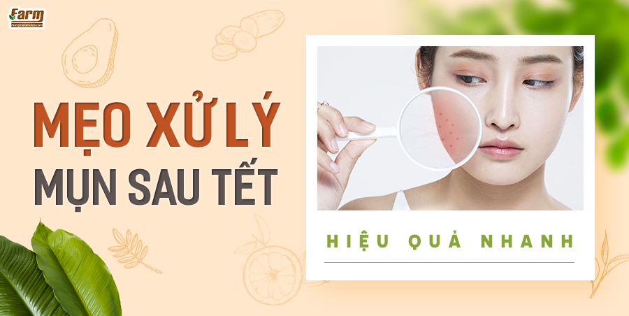 Mẹo Xử Lý Mụn Sau Tết Hiệu Quả Nhanh