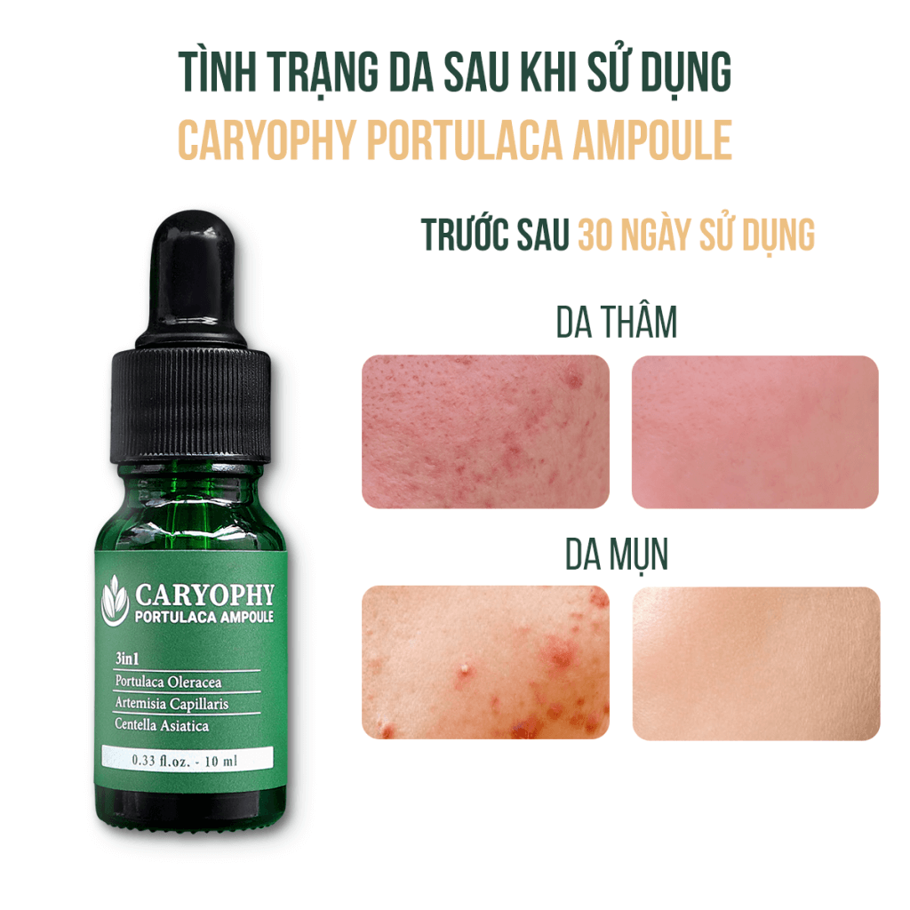 Serum đặc trị các loại mụn Caryophy Portulaca Ampoule