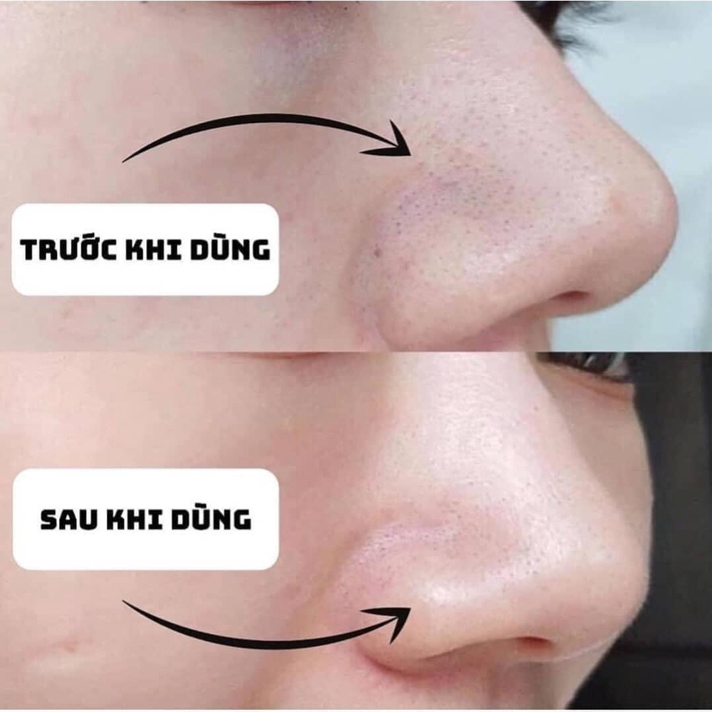 Thanh lăn mụn đầu đen Mamonade có thực sự hiệu quả như lời đồn?