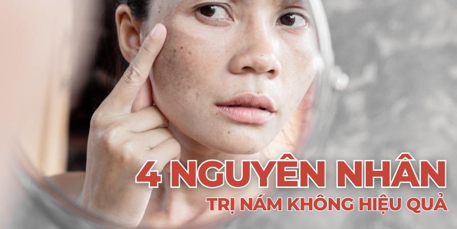 4 nguyên nhân trị nám không hiệu quả
