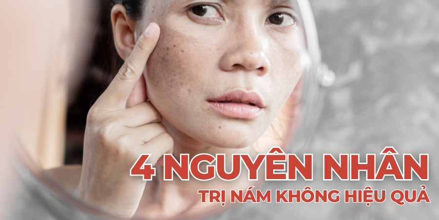 4 Nguyên nhân khiến việc trị nám của bạn không đạt hiệu quả như ý