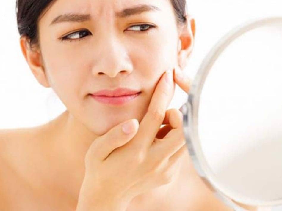 Vì sao uống Collagen bị nổi mụn và cách khắc phục