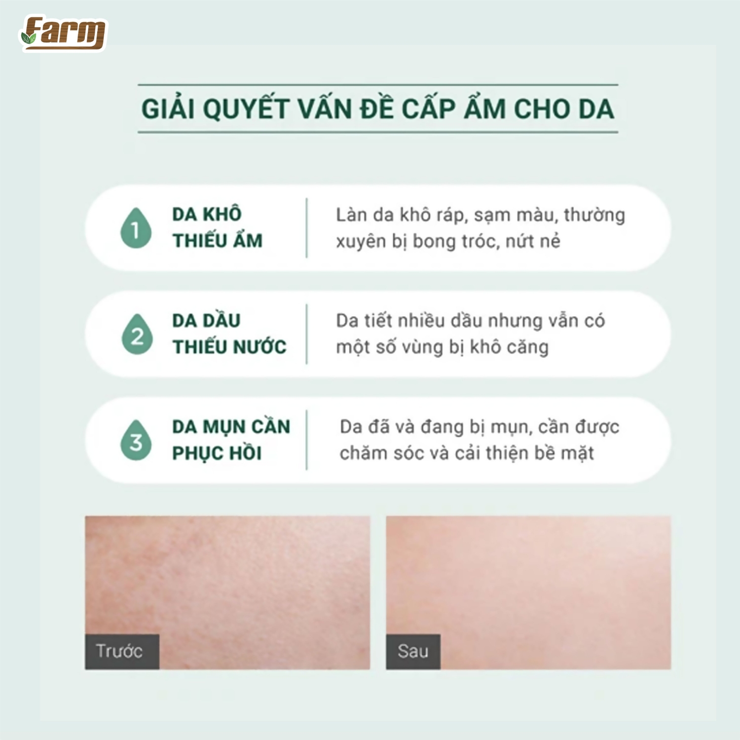Kem Dưỡng Cấp Nước, Phục Hồi Da Mụn Nhạy Cảm Caryophy 40ml